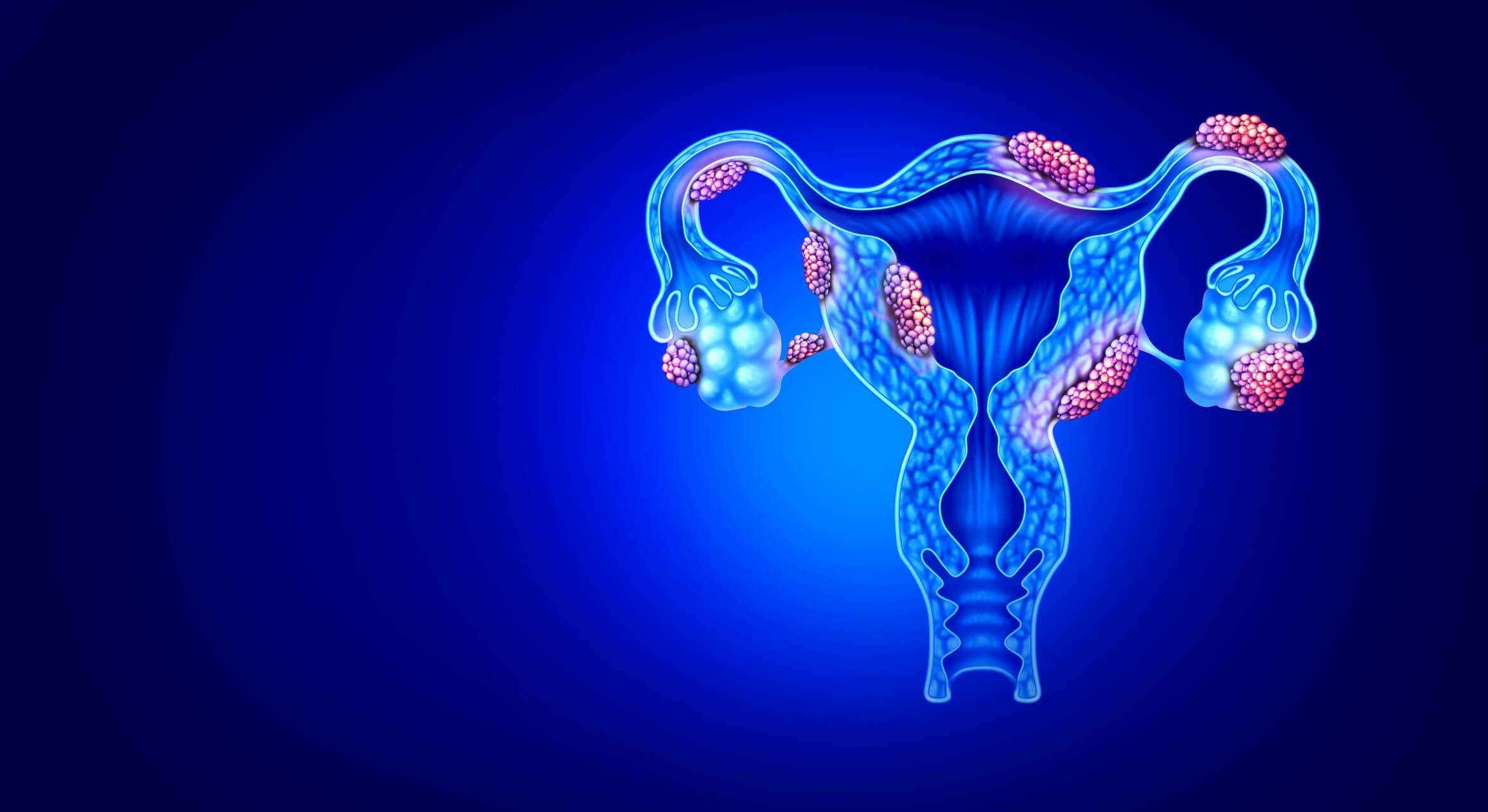 Endometriosi, una giornata di sensibilizzazione a Crema